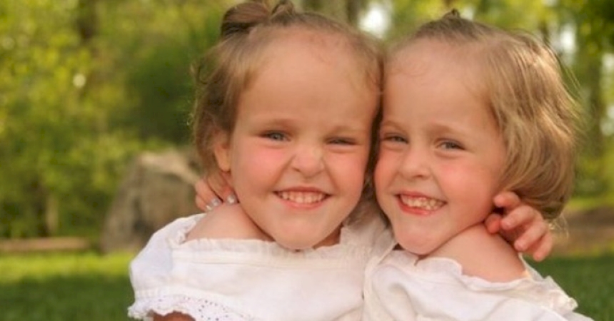 «They are already separated!» Surprisingly, these Siamese twins were separated when they were 4-years-old